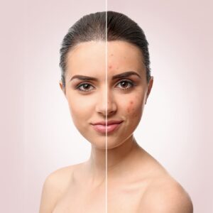Spots Treatment